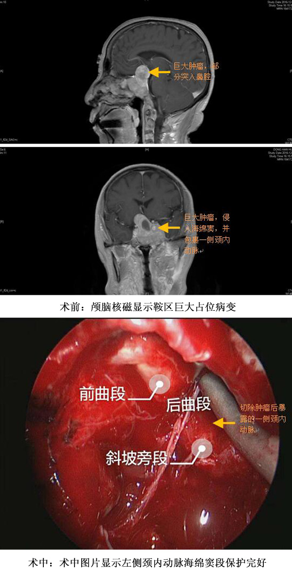 神经外科成功实施神经内镜下鼻孔入路巨大侵袭性垂体瘤微创手术治疗