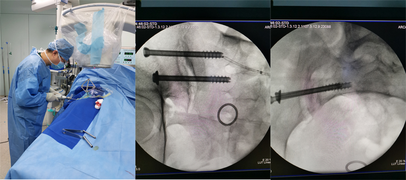 滨医附院创伤骨科完成首例骨科手术机器人辅助骨盆骶髂螺钉置入术