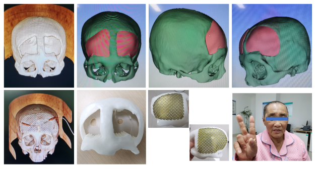 滨医附院成功实施3D打印塑形钛网植入术639.png