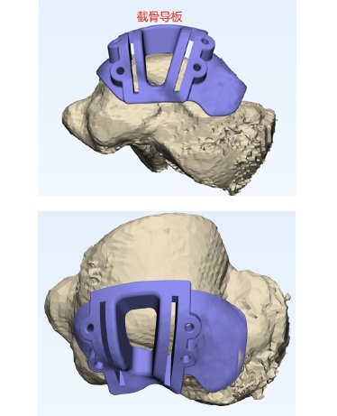 精准截骨导板设计.png